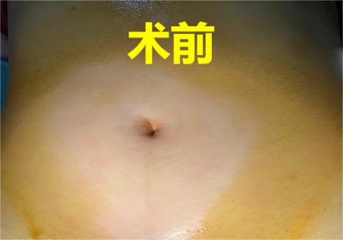 宜宾市叙州区妇幼保健院成功开展首例单孔腹腔镜手术