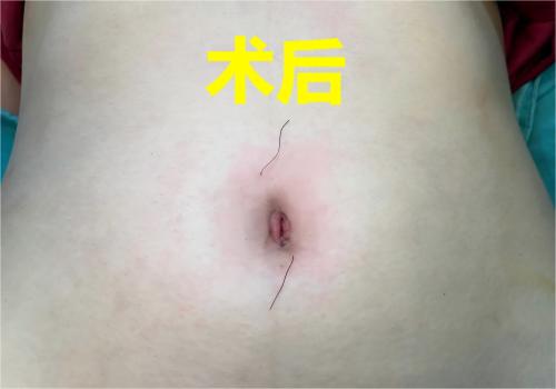 宜宾市叙州区妇幼保健院成功开展首例单孔腹腔镜手术