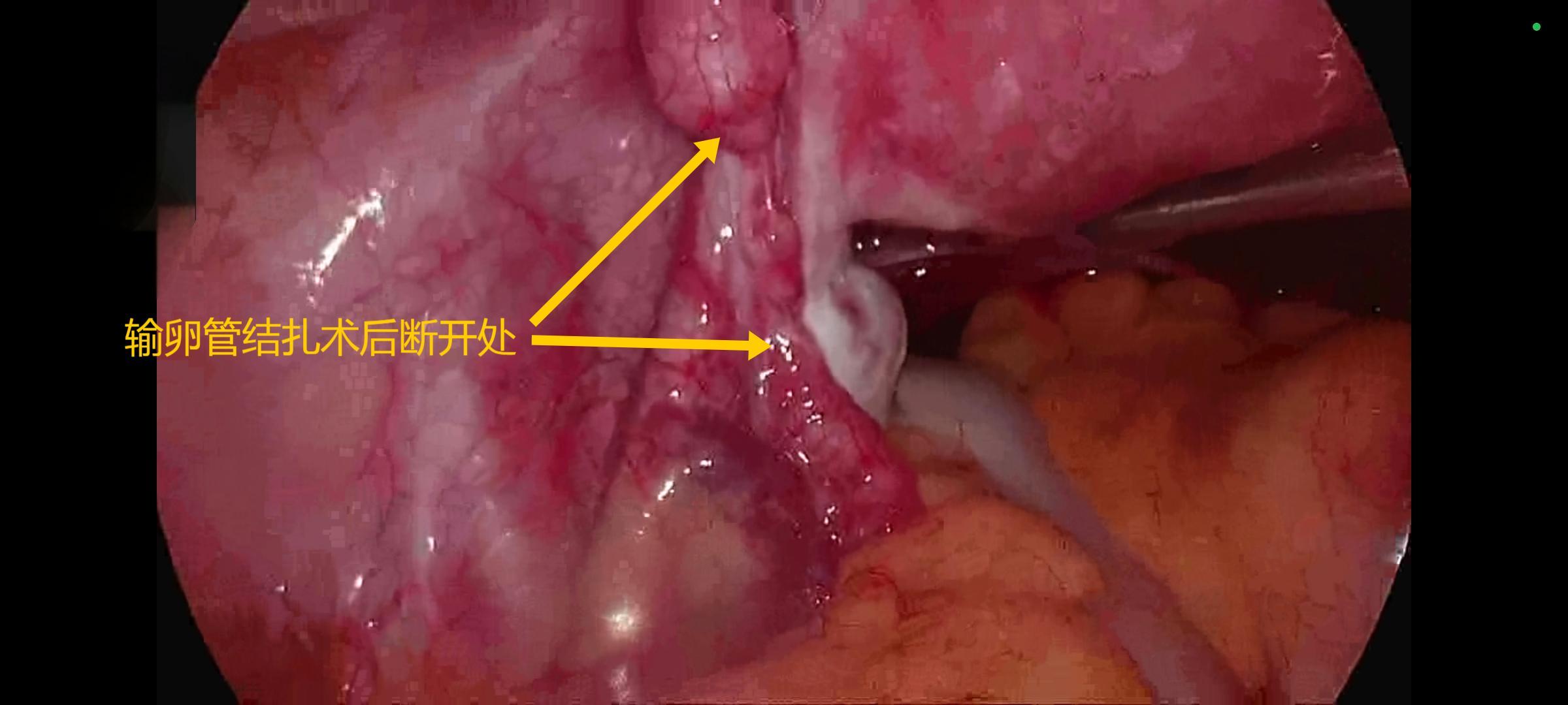 微创输卵管复通  圆您勃勃“生”机 ——区妇计中心成功实施腹腔镜下输卵管复通术