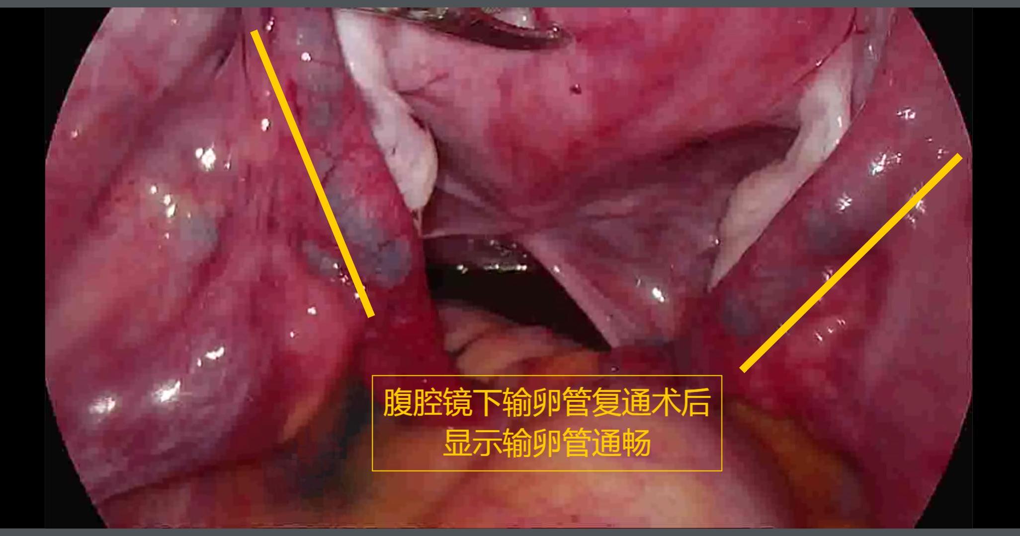微创输卵管复通  圆您勃勃“生”机 ——区妇计中心成功实施腹腔镜下输卵管复通术